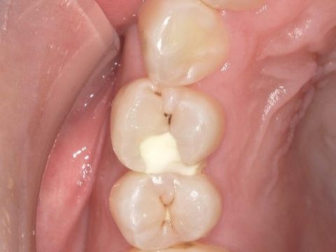 セラミックインレー　20代女性