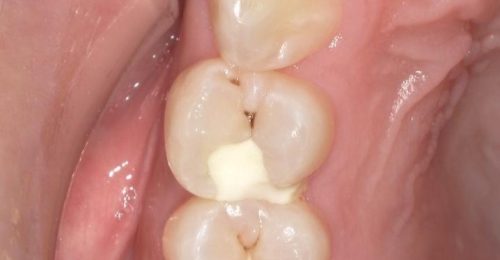 セラミックインレー　20代女性