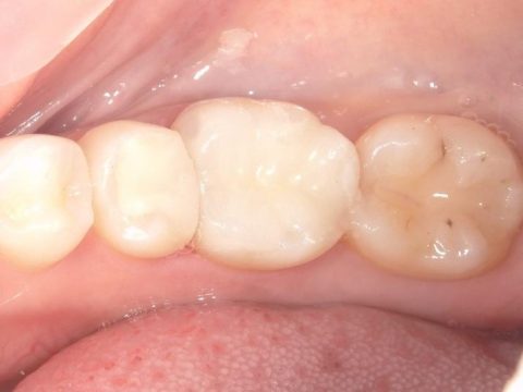 セラミックインレー 30代女性