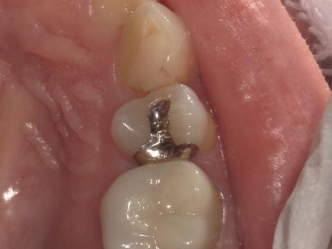 セラミックインレー　30代女性