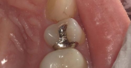 セラミックインレー　30代女性