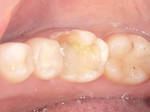 セラミックインレー 30代女性