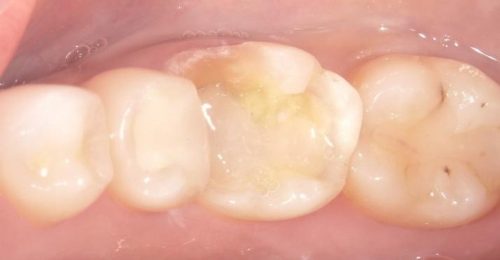 セラミックインレー　30代女性